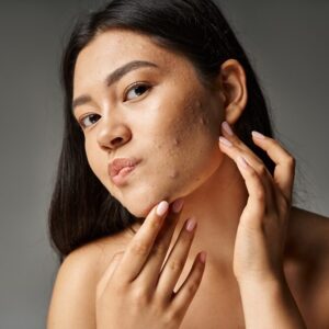 Anti-Acne Facial