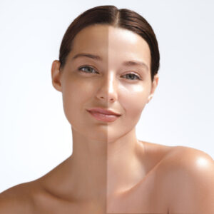 Face and Neck Detan